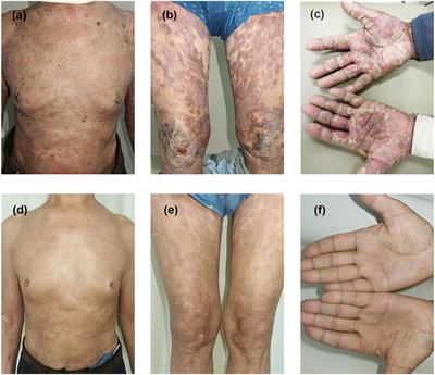 Anti-interleukin 4 receptor α antibody for the treatment of Chinese bullous pemphigoid patients with diverse comorbidities and a 1-year follow-up: a monocentric real-world study